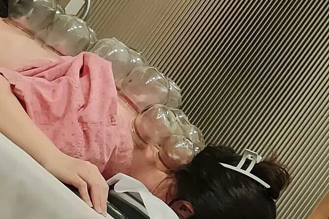 Acupuncture and Suction Cups Session at the Hospital - What the Experience Entails