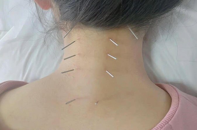 Acupuncture and Suction Cups Session at the Hospital - Final Thoughts: Is It Worth It?