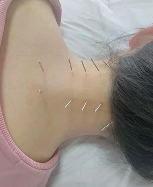 Shanghai: Chinese Medicine Acupuncture and Cupping Session - Who Will Love This Experience?
