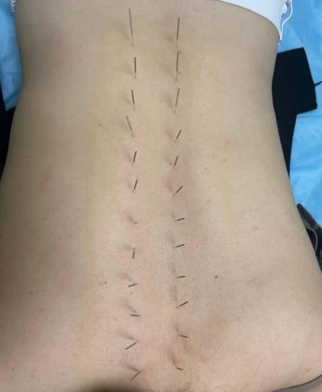 Traditional Chinese Medicine AcupunctureCupping Experience - What to Expect During the Session